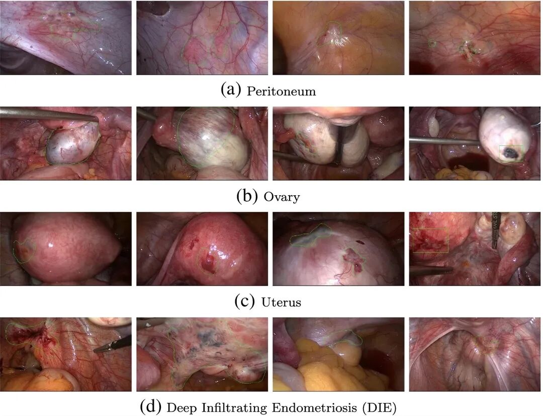 腹腔镜下子宫内膜异位症分型：腹膜型、卵巢型、子宫型、深部浸润型 DIE（图片：Leibetseder et al. / Wikimedia Commons，CC BY 4.0）