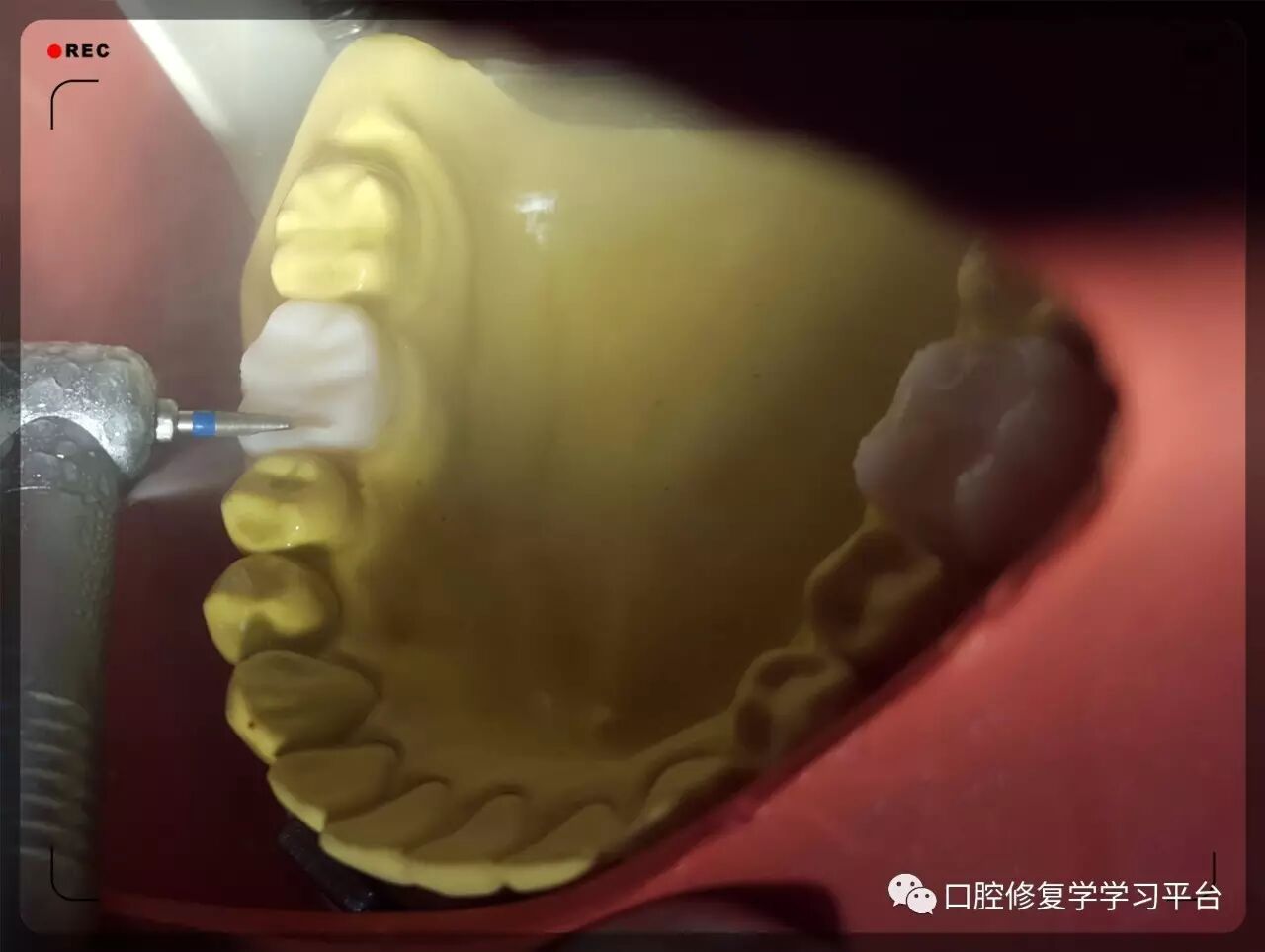 磨牙铸造金属全冠的牙体预备2.0(学生版)