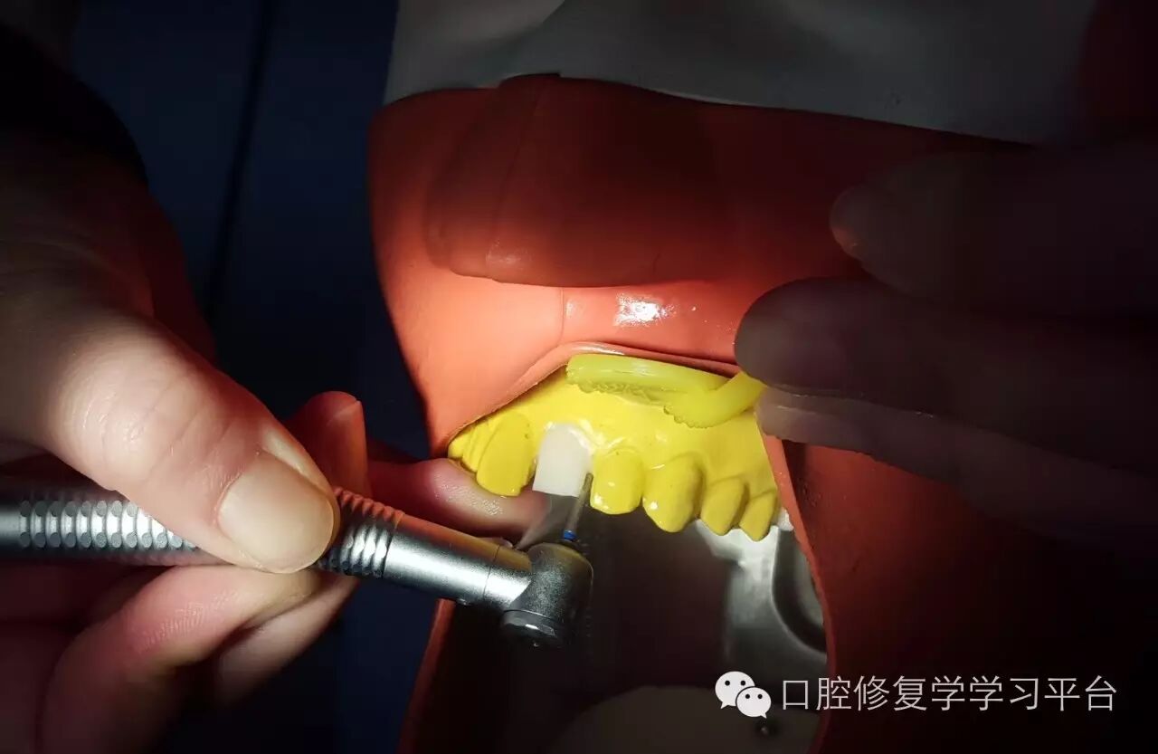 前牙金属烤瓷全冠的牙体预备