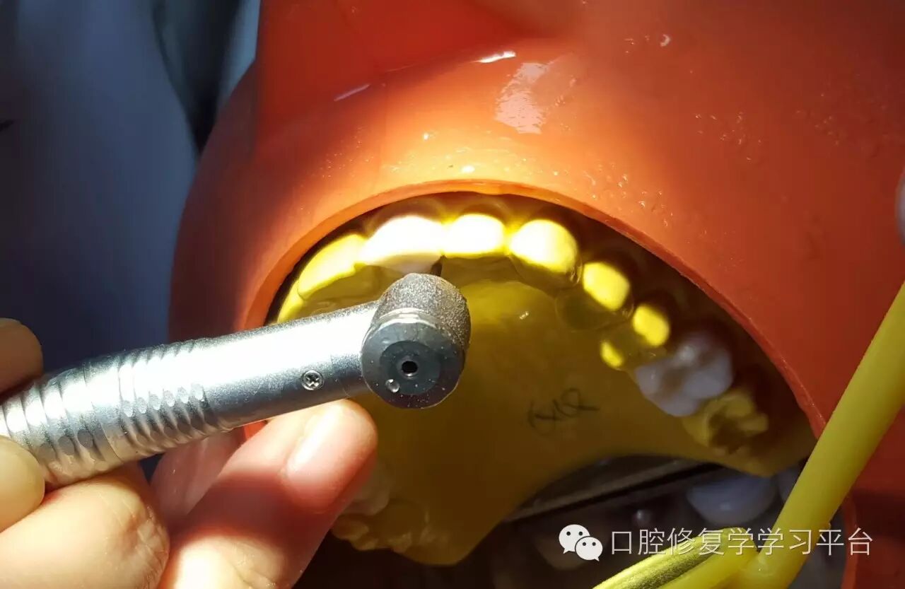 前牙金属烤瓷全冠的牙体预备