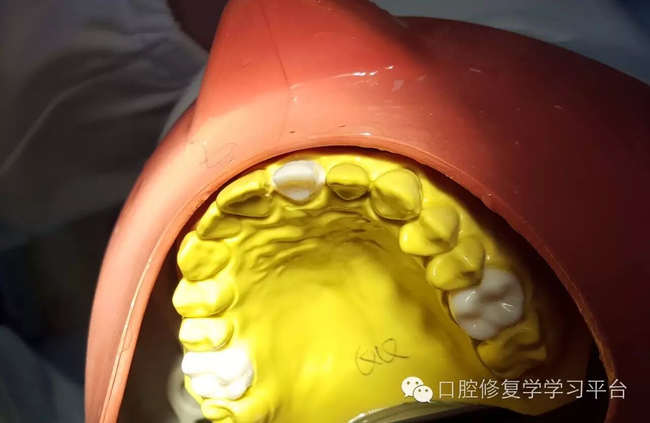 前牙金属烤瓷全冠的牙体预备