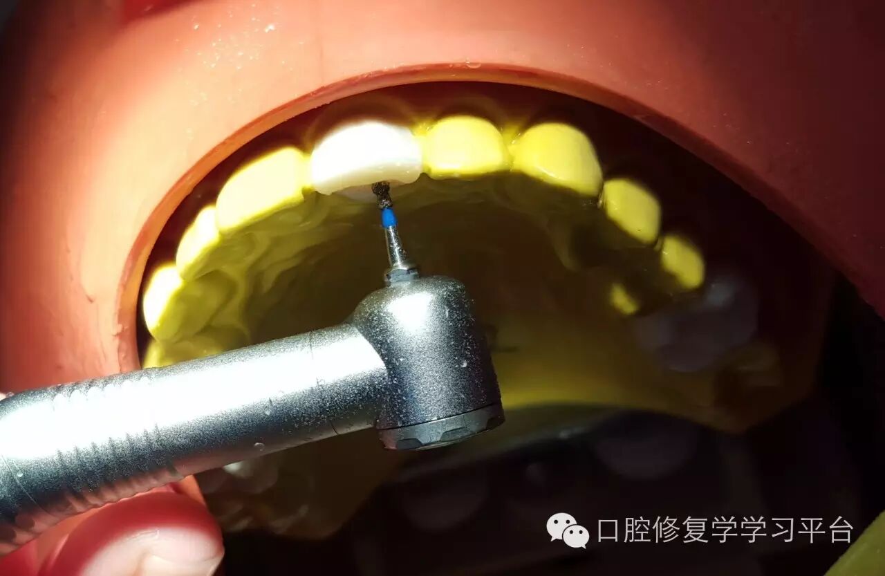 前牙金属烤瓷全冠的牙体预备