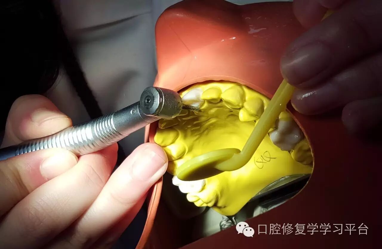 前牙金属烤瓷全冠的牙体预备