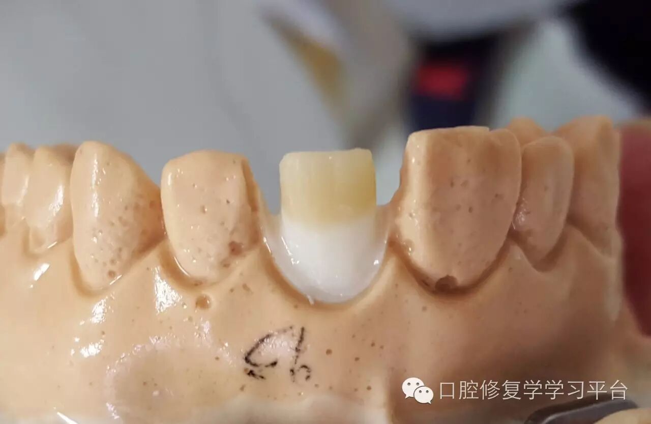 前牙金属烤瓷全冠的牙体预备