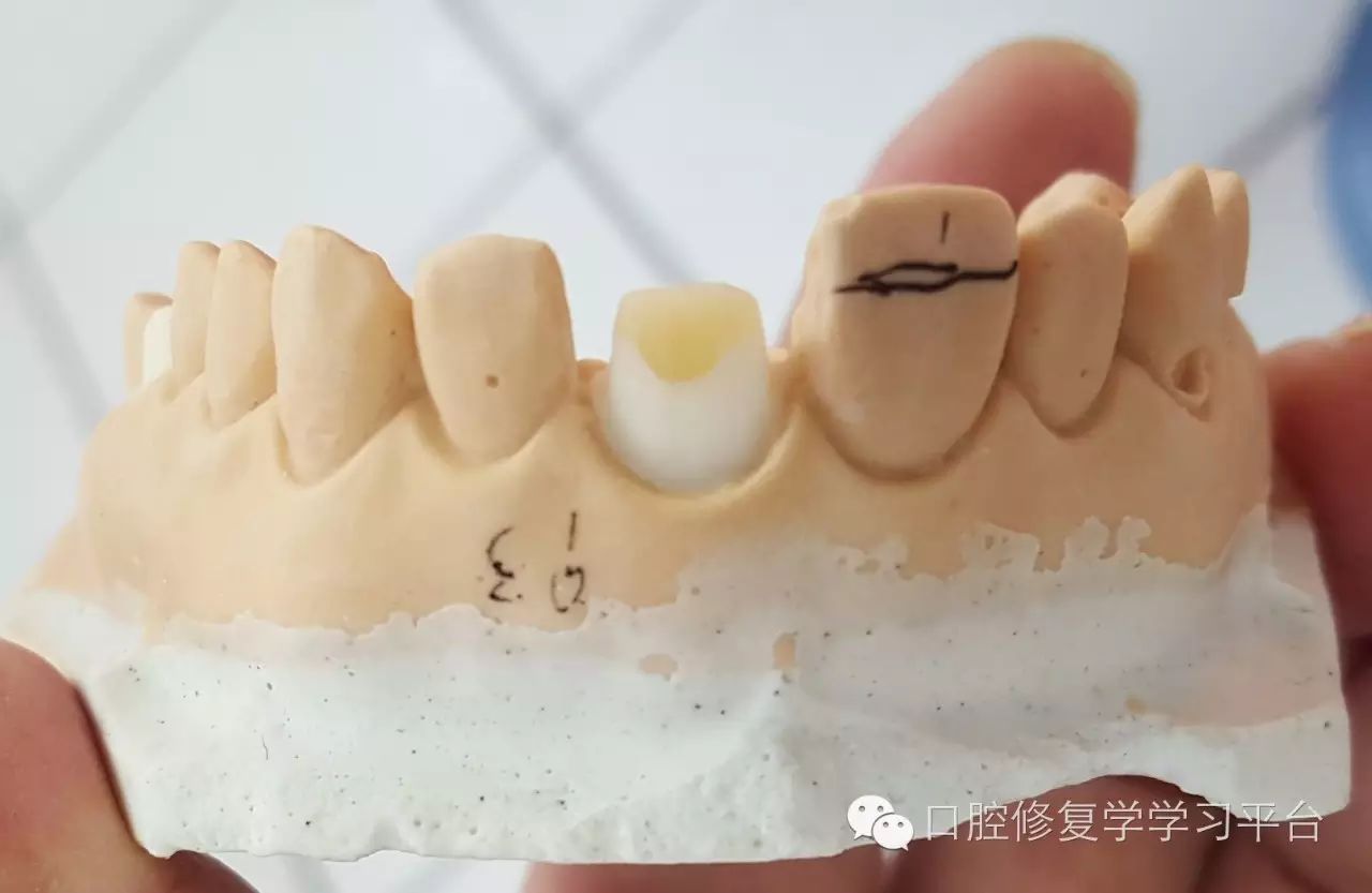 前牙三类洞型预备图片图片