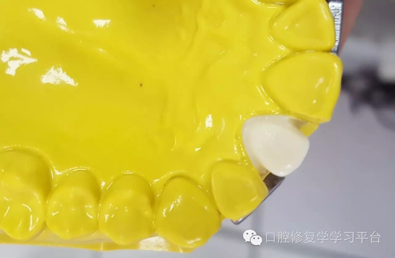 前牙金属烤瓷全冠的牙体预备