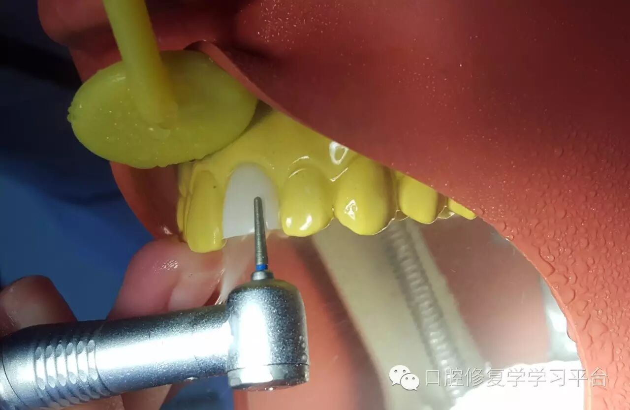 前牙金属烤瓷全冠的牙体预备