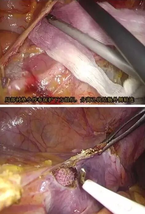 纱布片怎么使用方法腔镜手术中软纱布有什么用_https://www.jmylbn.com_新闻资讯_第3张
