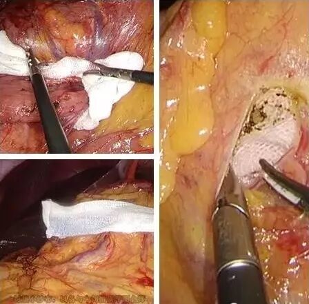 纱布片怎么使用方法腔镜手术中软纱布有什么用_https://www.jmylbn.com_新闻资讯_第5张