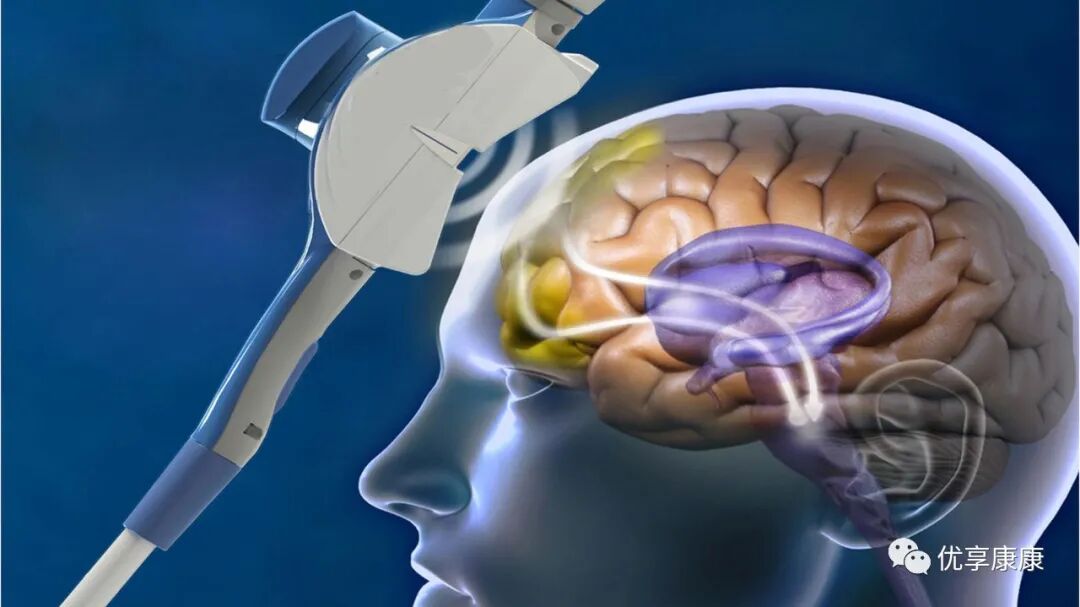 tms什么医疗康复基础 ｜ 重复经颅磁刺激(TMS)治疗专家共识，点击共识！_https://www.jmylbn.com_新闻资讯_第3张