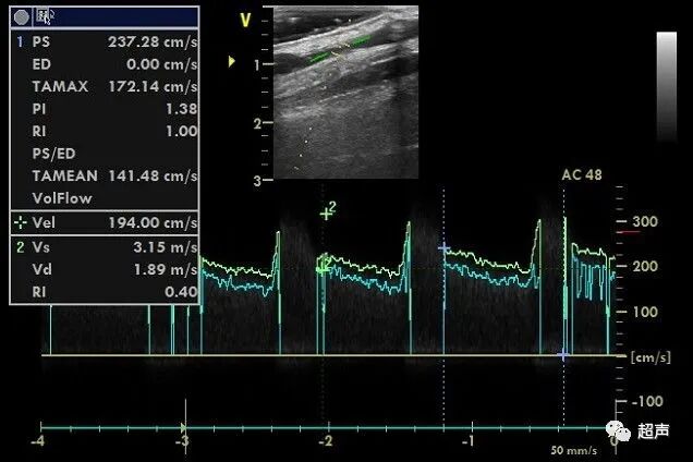 什么是超声容积探头血流量测定 ｜取样容积和角度θ_https://www.jmylbn.com_新闻资讯_第14张