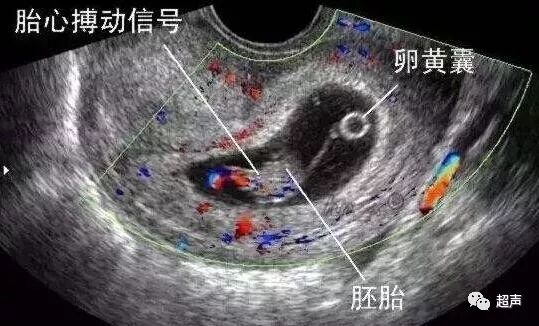 流产症状 超声 国内新闻