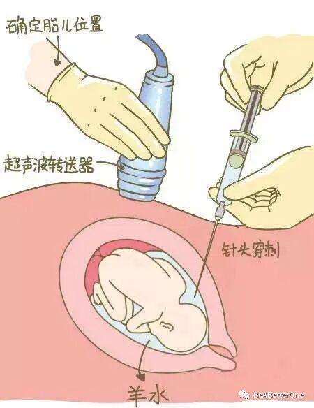 无创建议做基础班还是升级版_无创建议做几项指标的_不建议做无创plus