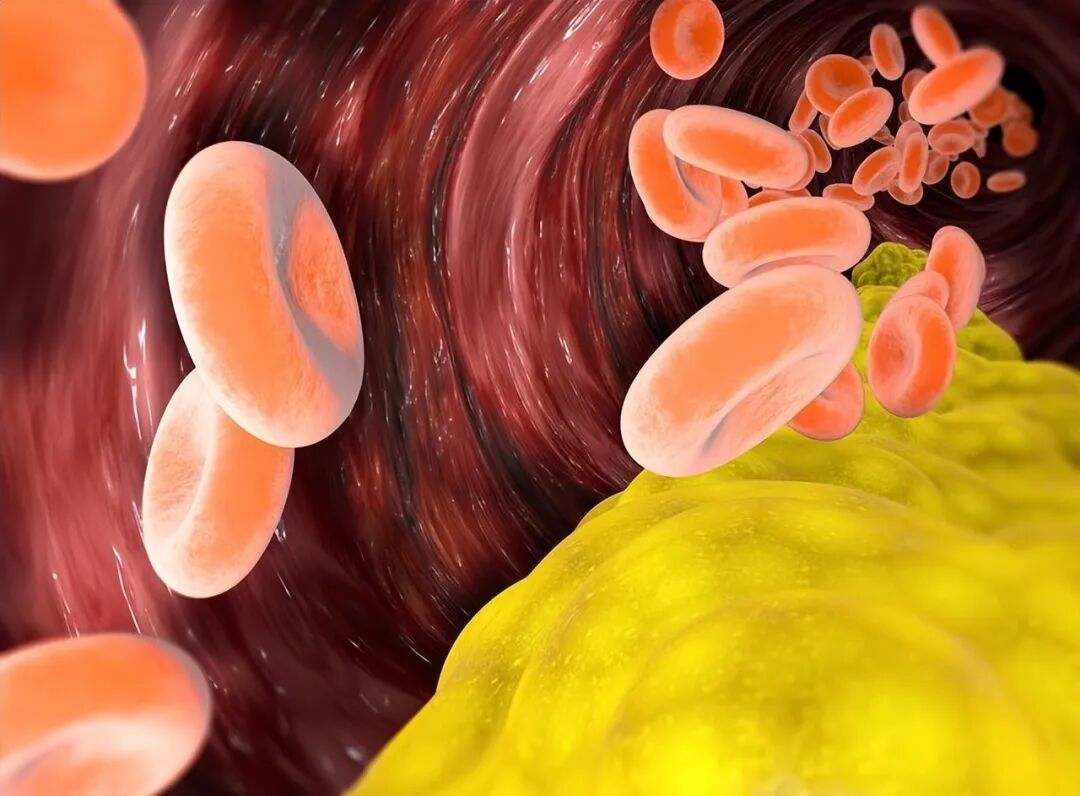 第一次吃他汀类药物，要注意什么，这5点要记好！