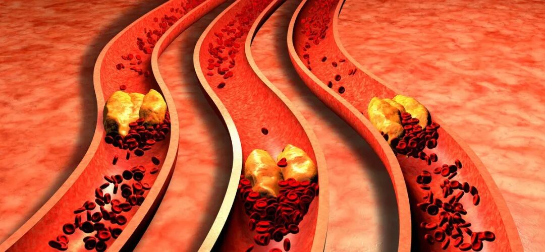 颈动脉有斑块，吃他汀类药物使斑块缩小后，可以暂停服用吗？