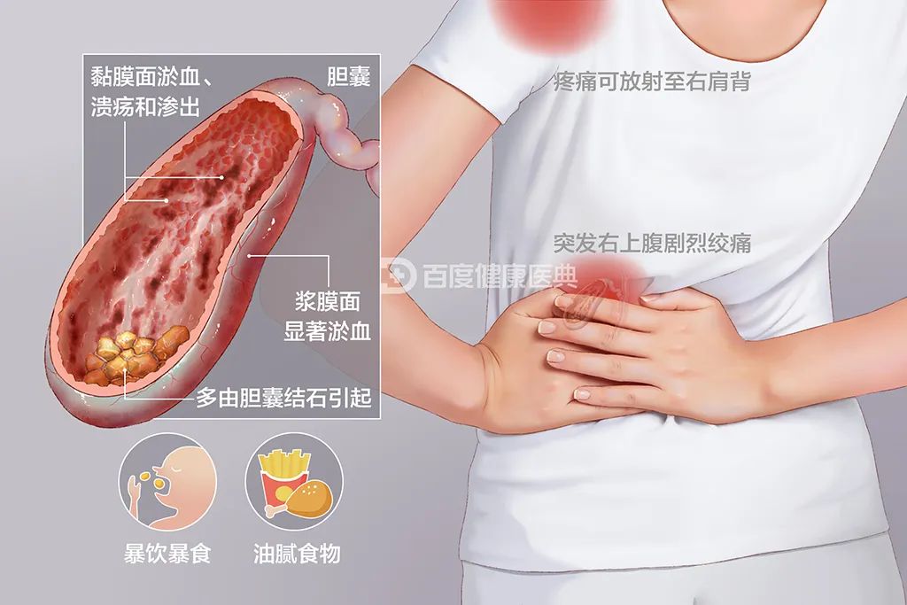 医生表示，胆囊炎通常不会危害生命。主要症状为发热，腹痛。但少部分急