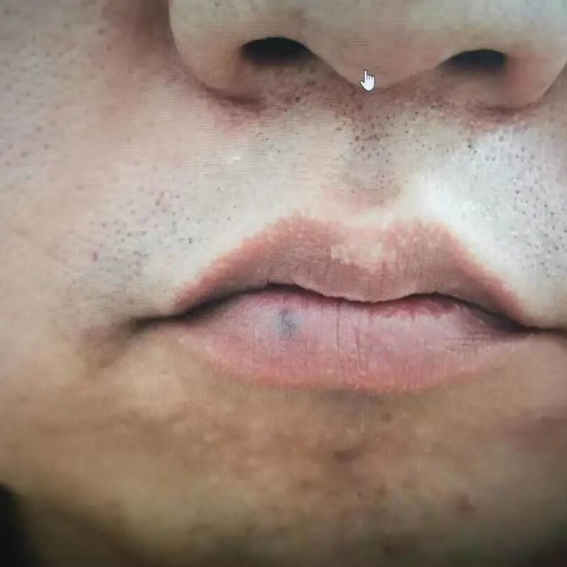 医用皮肤镜什么牌子好长痣、红肿、瘙痒、脱发......感觉自己得了皮肤病？皮肤镜检查为您一探究竟！_https://www.jmylbn.com_新闻资讯_第2张