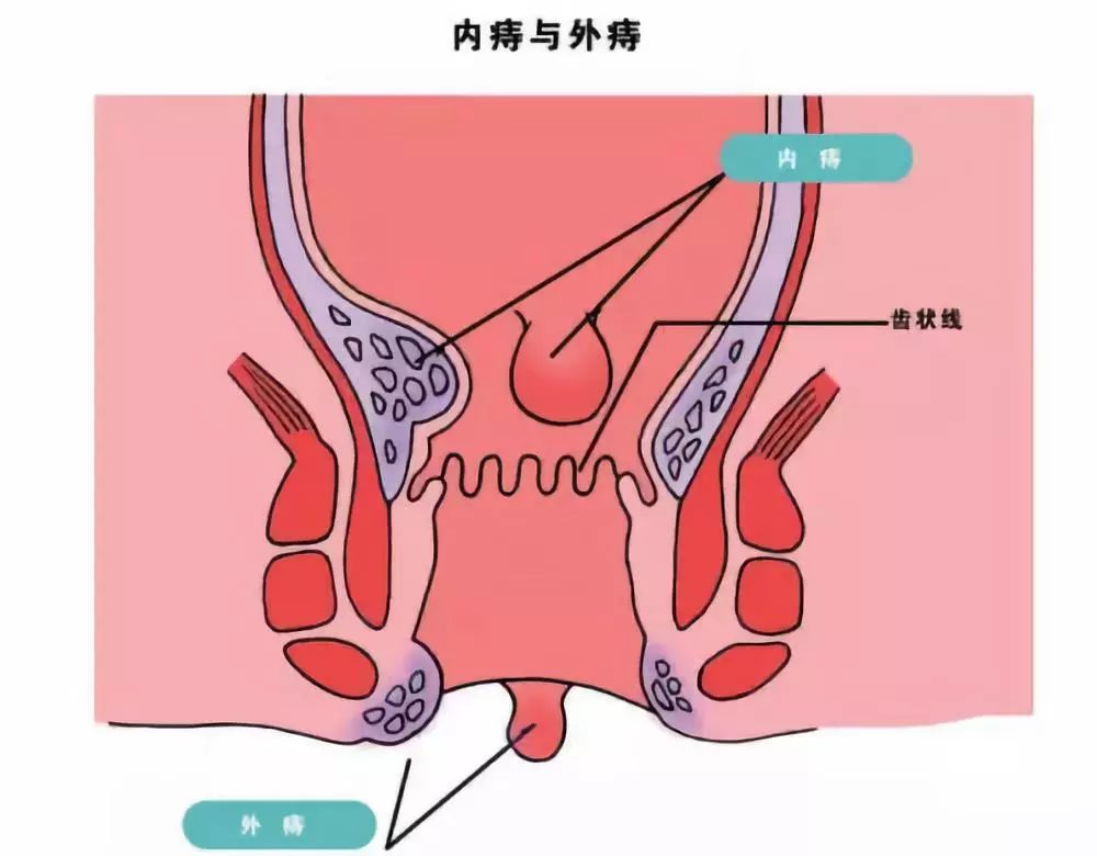 内痔 外痔 混合痔 怎么区分 临汾友好医院 微信公众号文章阅读 Wemp