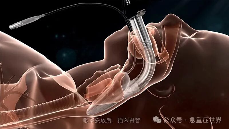 为什么要用喉罩如何正确使用喉罩？这篇讲全了！_https://www.jmylbn.com_新闻资讯_第12张