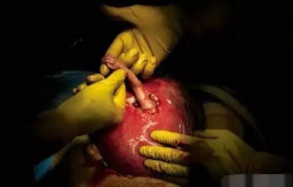 怎么用手抓到子宫21周的胎儿从子宫伸出“希望之手”抓住医生，生命的奇迹！_https://www.jmylbn.com_新闻资讯_第9张