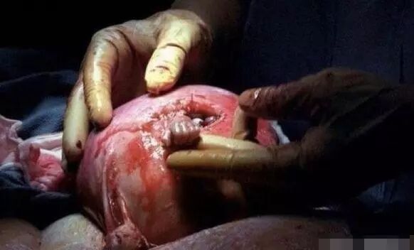 怎么用手抓到子宫21周的胎儿从子宫伸出“希望之手”抓住医生，生命的奇迹！_https://www.jmylbn.com_新闻资讯_第3张