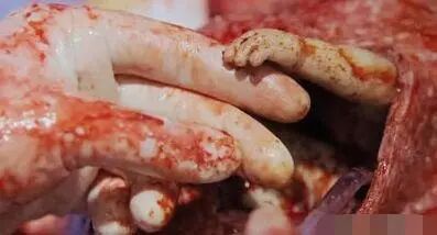 怎么用手抓到子宫21周的胎儿从子宫伸出“希望之手”抓住医生，生命的奇迹！_https://www.jmylbn.com_新闻资讯_第1张