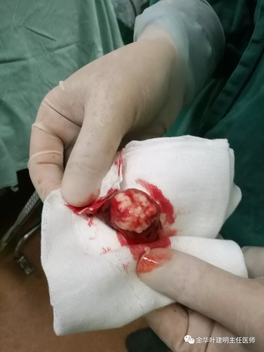 6):不一样的错构瘤_医学界-助力医生临床决策和职业成长