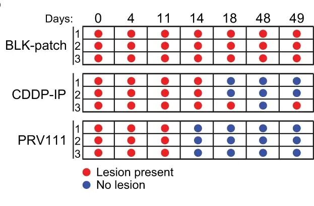 Nature Communications：  纳米工程化顺铂递送系统治疗口腔癌的临床研究