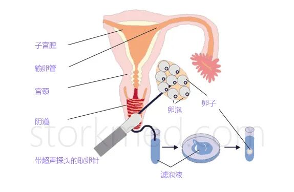 取卵针什么样的【干货】取卵针取卵过程图，做试管婴儿记得收藏！_https://www.jmylbn.com_新闻资讯_第3张
