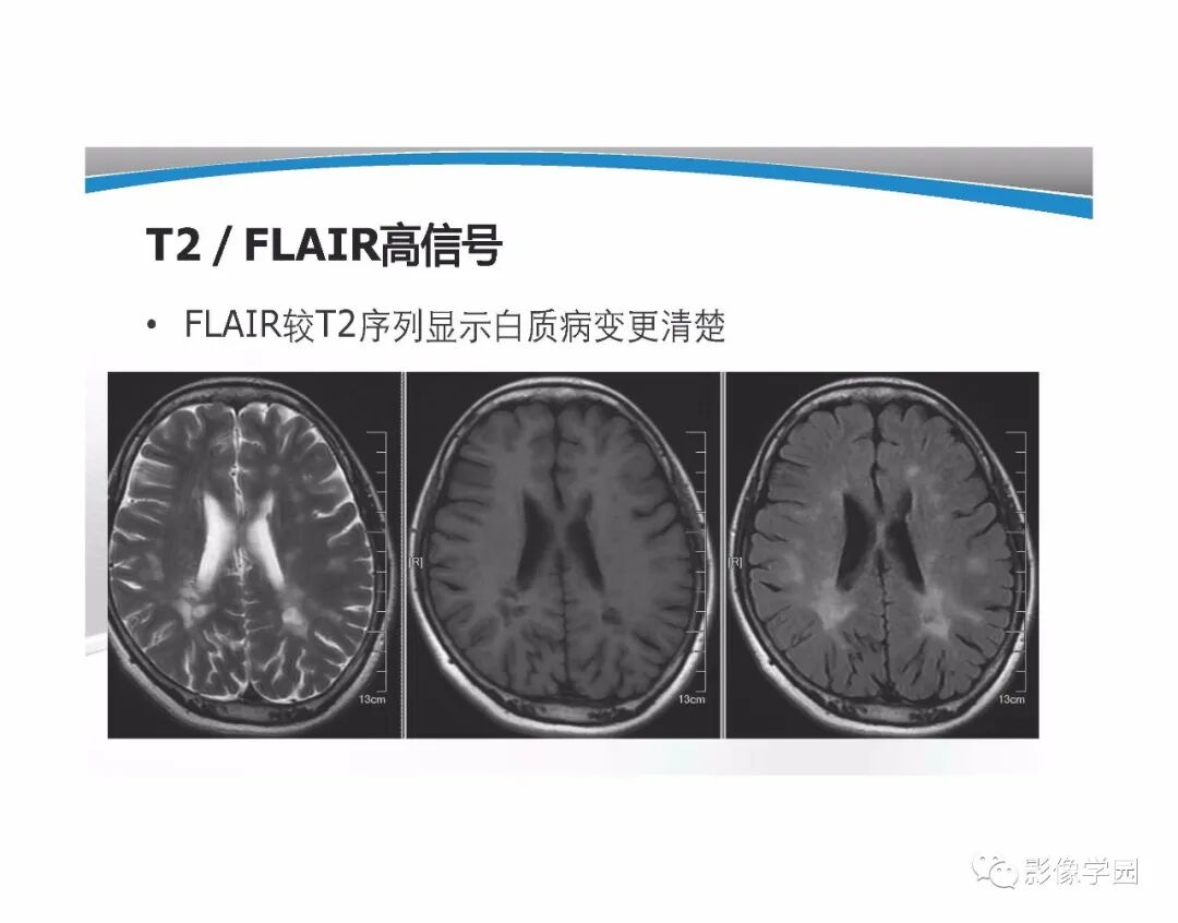 t1wi、t2wi 及 flair 信号分析与颅内病变图像判读！