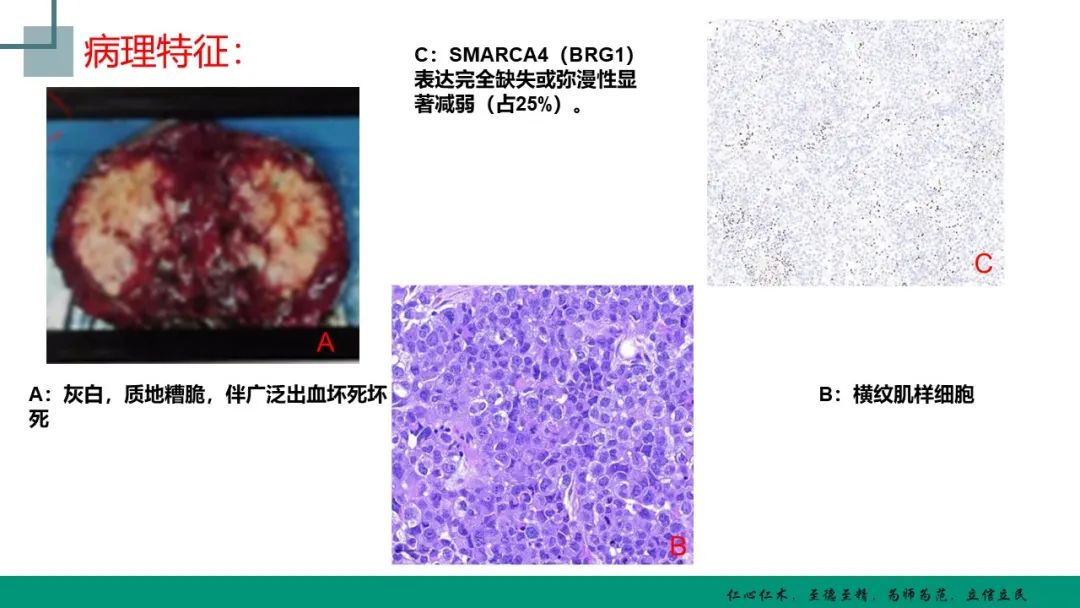 罕见病胸部smarca4缺失的未分化肿瘤影像表现