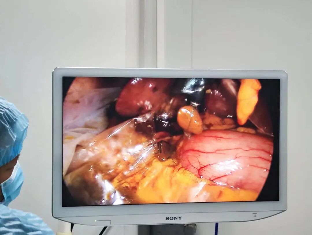 狼牌胆道镜怎么装新技术丨我院成功开展腹腔镜下微创胆道镜手术（LCBDE），快来了解一下！_https://www.jmylbn.com_新闻资讯_第7张
