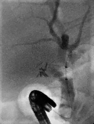 取石球囊怎么使用取石球囊被卡住？ERCP治疗胆总管结石一例罕见并发症_https://www.jmylbn.com_新闻资讯_第5张