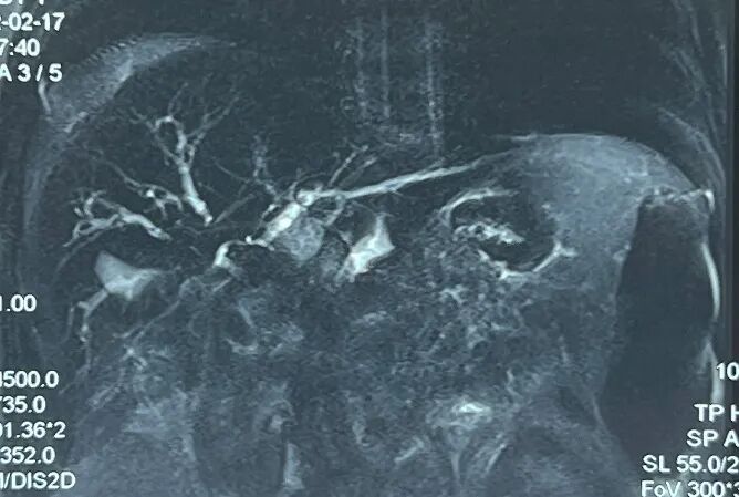 胆管支架什么样子内镜下三金属支架置入术治疗肝门胆管恶性狭窄_https://www.jmylbn.com_新闻资讯_第2张