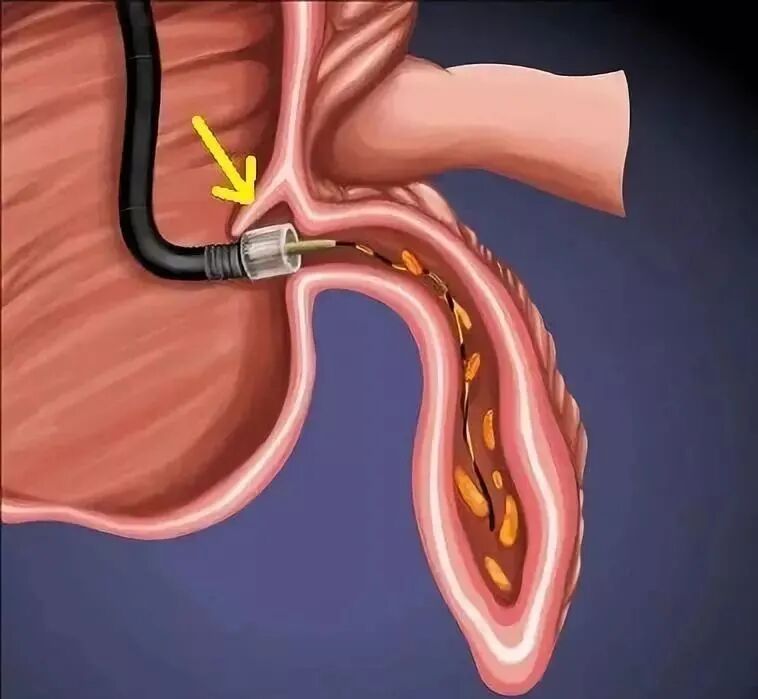 斑马导丝是治疗什么的阑尾炎也可以不开刀——内镜逆行性阑尾炎治疗术（ERAT）_https://www.jmylbn.com_新闻资讯_第8张