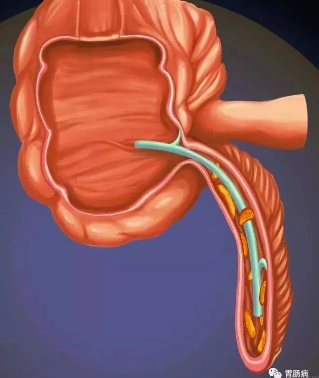 斑马导丝是治疗什么的阑尾炎也可以不开刀——内镜逆行性阑尾炎治疗术（ERAT）_https://www.jmylbn.com_新闻资讯_第15张