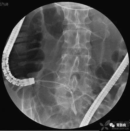 斑马导丝是治疗什么的阑尾炎也可以不开刀——内镜逆行性阑尾炎治疗术（ERAT）_https://www.jmylbn.com_新闻资讯_第17张