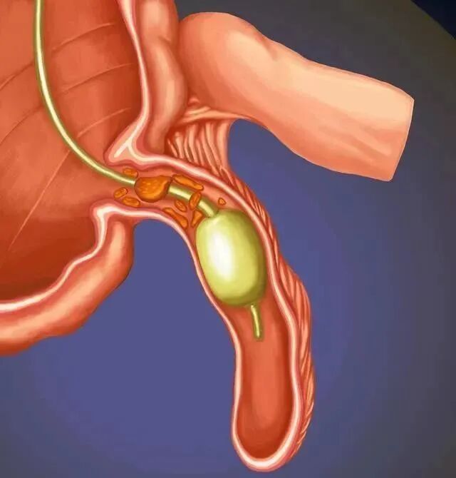 斑马导丝是治疗什么的阑尾炎也可以不开刀——内镜逆行性阑尾炎治疗术（ERAT）_https://www.jmylbn.com_新闻资讯_第12张