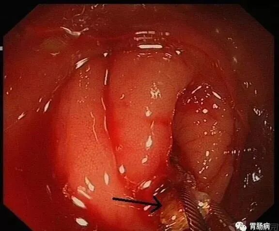 斑马导丝是治疗什么的阑尾炎也可以不开刀——内镜逆行性阑尾炎治疗术（ERAT）_https://www.jmylbn.com_新闻资讯_第14张