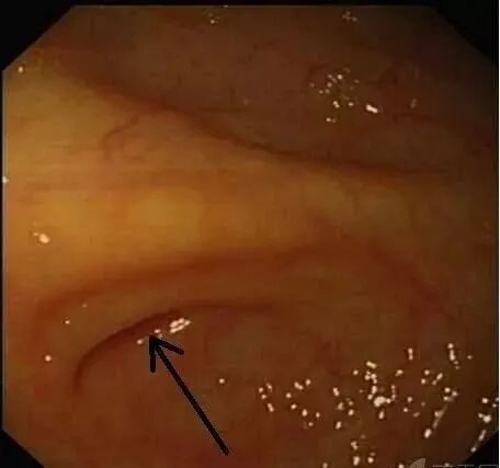 斑马导丝是治疗什么的阑尾炎也可以不开刀——内镜逆行性阑尾炎治疗术（ERAT）_https://www.jmylbn.com_新闻资讯_第18张