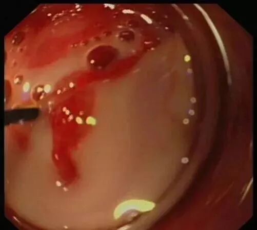 斑马导丝是治疗什么的阑尾炎也可以不开刀——内镜逆行性阑尾炎治疗术（ERAT）_https://www.jmylbn.com_新闻资讯_第10张