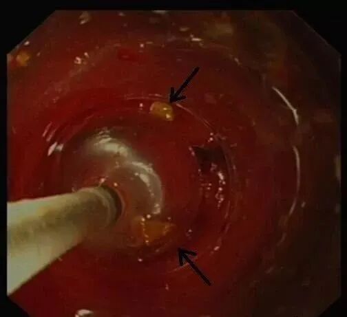 斑马导丝是治疗什么的阑尾炎也可以不开刀——内镜逆行性阑尾炎治疗术（ERAT）_https://www.jmylbn.com_新闻资讯_第13张