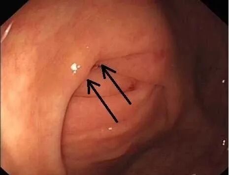 斑马导丝是治疗什么的阑尾炎也可以不开刀——内镜逆行性阑尾炎治疗术（ERAT）_https://www.jmylbn.com_新闻资讯_第7张