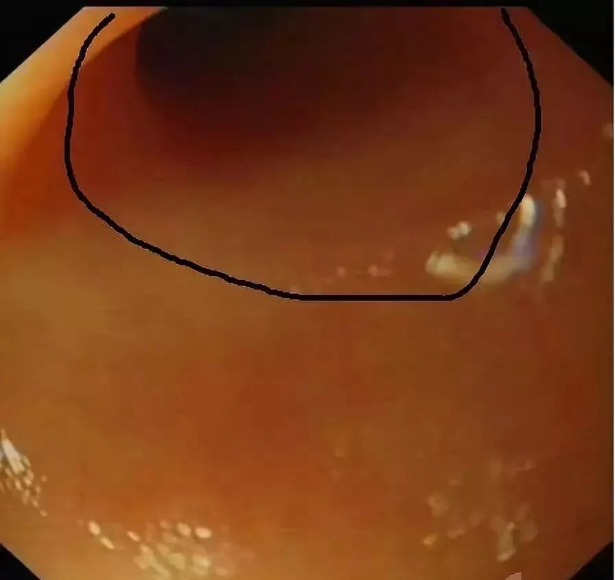 斑马导丝是治疗什么的阑尾炎也可以不开刀——内镜逆行性阑尾炎治疗术（ERAT）_https://www.jmylbn.com_新闻资讯_第19张