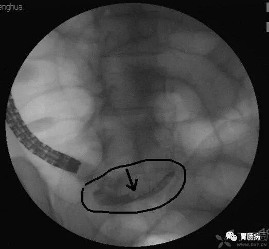 斑马导丝是治疗什么的阑尾炎也可以不开刀——内镜逆行性阑尾炎治疗术（ERAT）_https://www.jmylbn.com_新闻资讯_第11张
