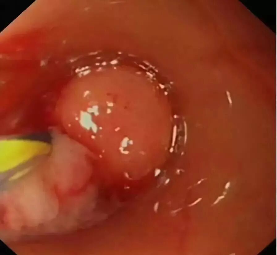 斑马导丝是治疗什么的阑尾炎也可以不开刀——内镜逆行性阑尾炎治疗术（ERAT）_https://www.jmylbn.com_新闻资讯_第9张