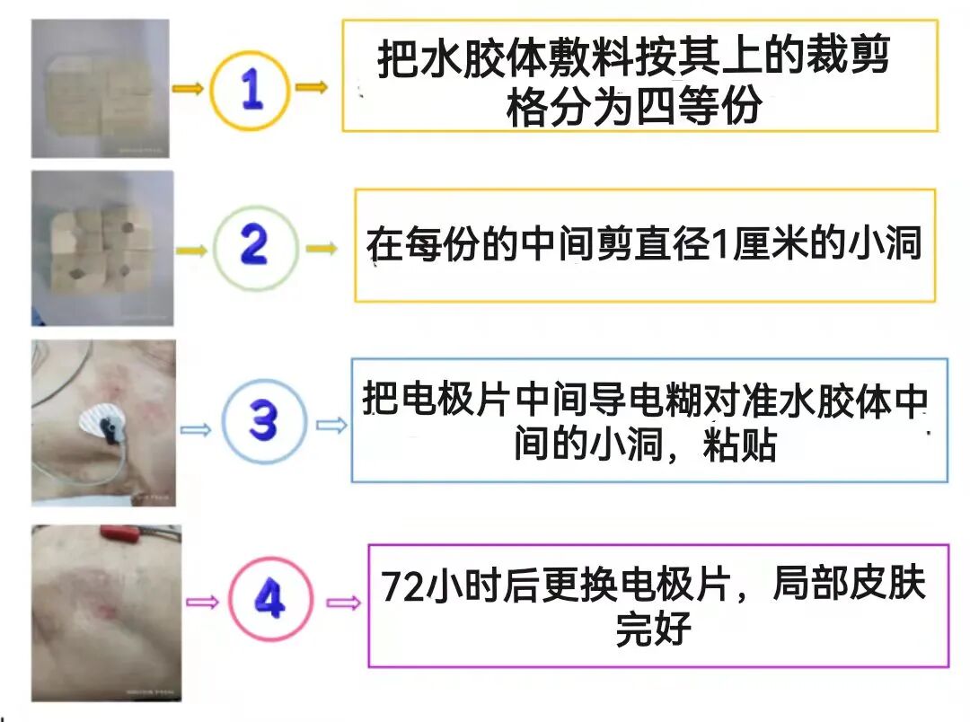 烧伤敷料怎么用图解患儿皮肤被电极片灼伤！看美小护这样处理！_https://www.jmylbn.com_新闻资讯_第3张