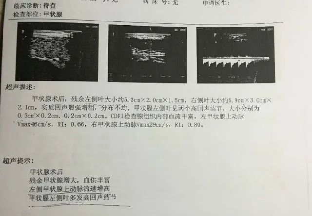 【小科普】甲状腺超声报告里的血流信号反映了什么问题？比医生早一步读懂报告