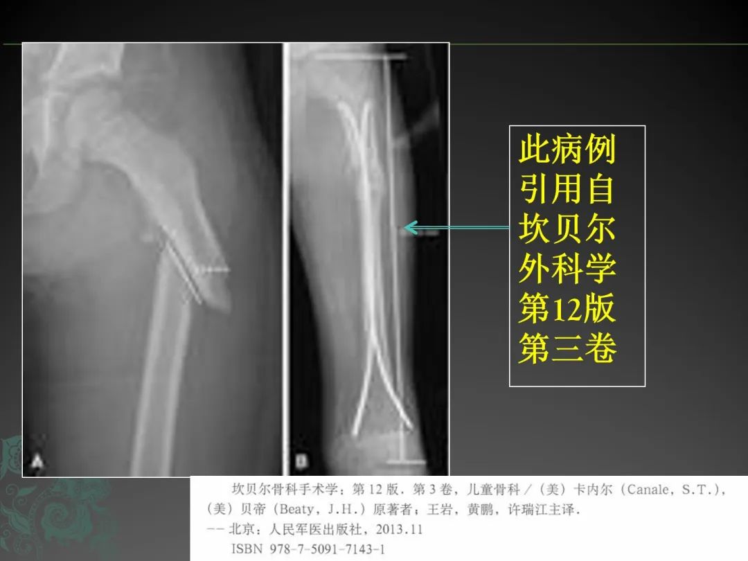 一篇课件读懂髓内钉治疗肱骨近端骨折