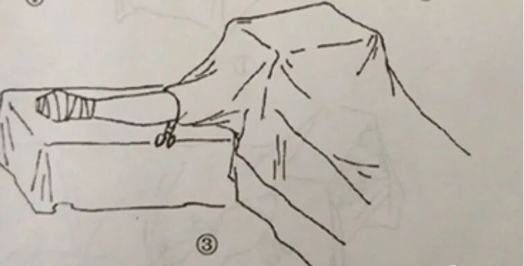 手术工具怎么消毒骨科手术消毒、铺巾操作，做好这几个细节事半功倍！_https://www.jmylbn.com_新闻资讯_第10张